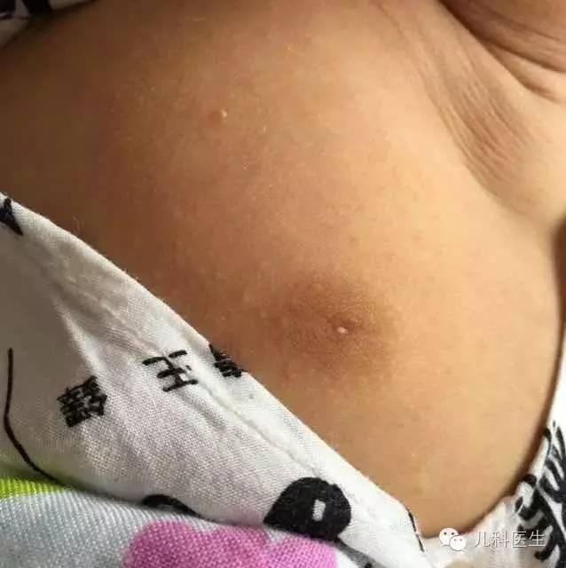 3个月宝宝乳头白点的观察与护理