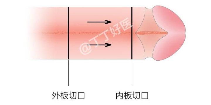 清宫术后半月小腹刺痛现象解析