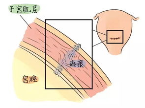 瘢痕子宫五个月引产，全面解析与注意事项