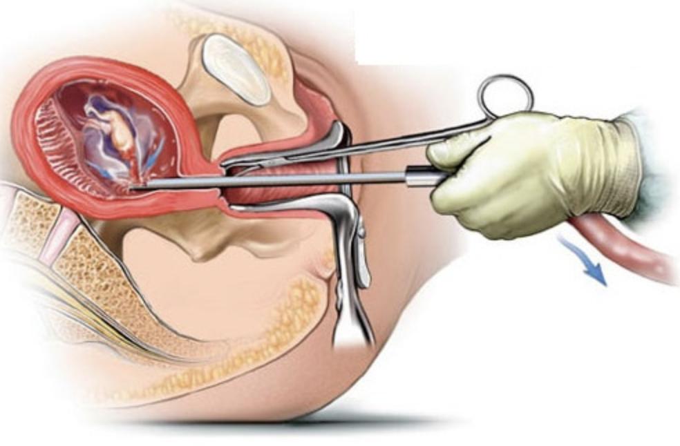四个月的孕期，如何选择人流手术？