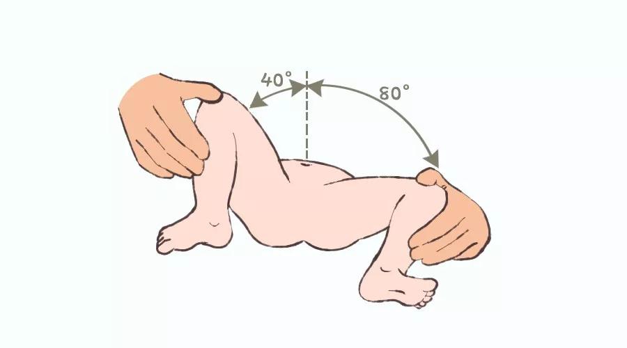 3个月宝宝腿纹不对称，原因、影响与应对策略