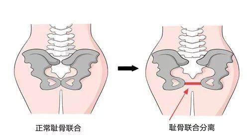 孕五个月耻骨疼痛与早产风险探讨