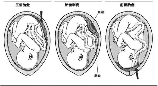 四个月胎盘低怎么办？专业指导与应对策略