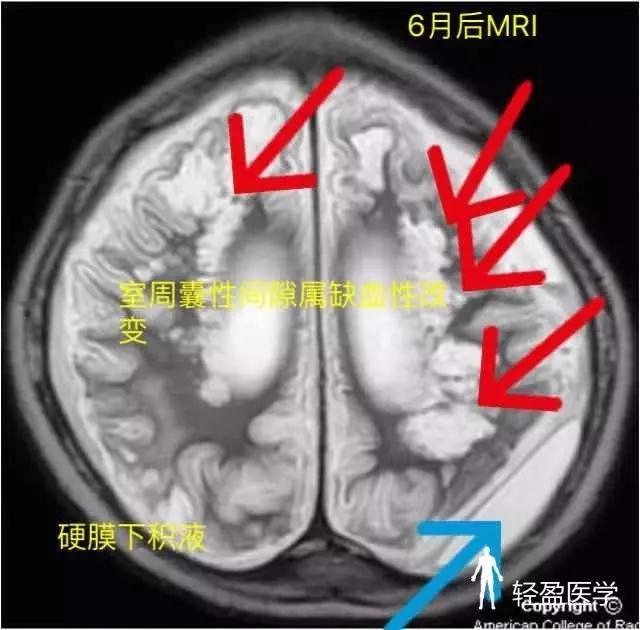 解析3个月宝宝呼吸急促现象