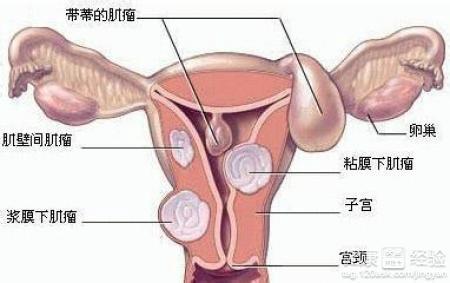 子宫切除术后半月出血的深度解析